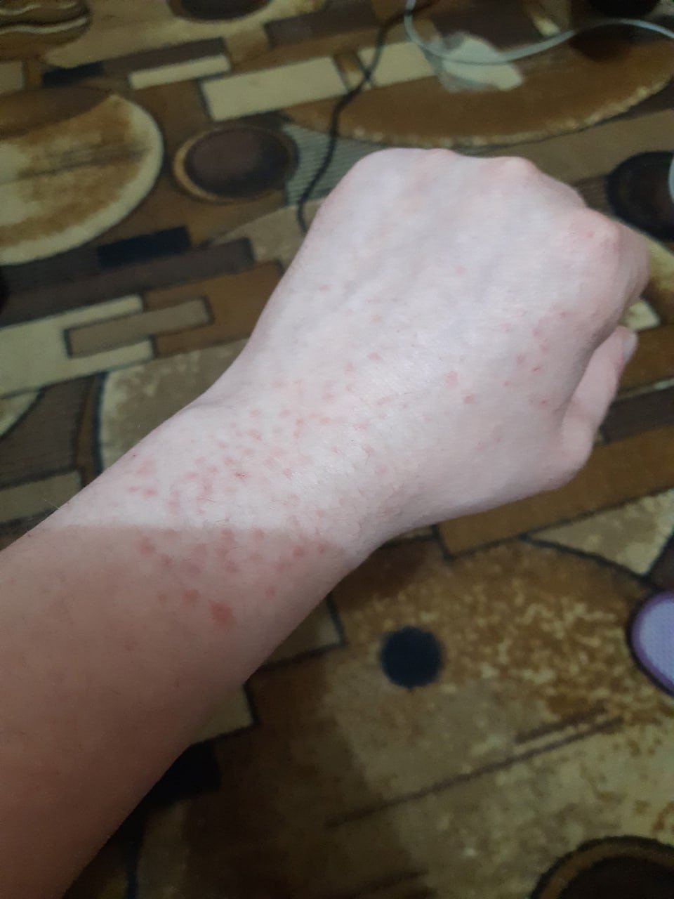 Кожные высыпания на теле жителя города Каменск-Шахтинский. Фото: Telegram